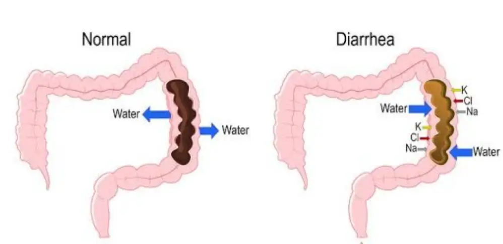 Causes of Diarrhea